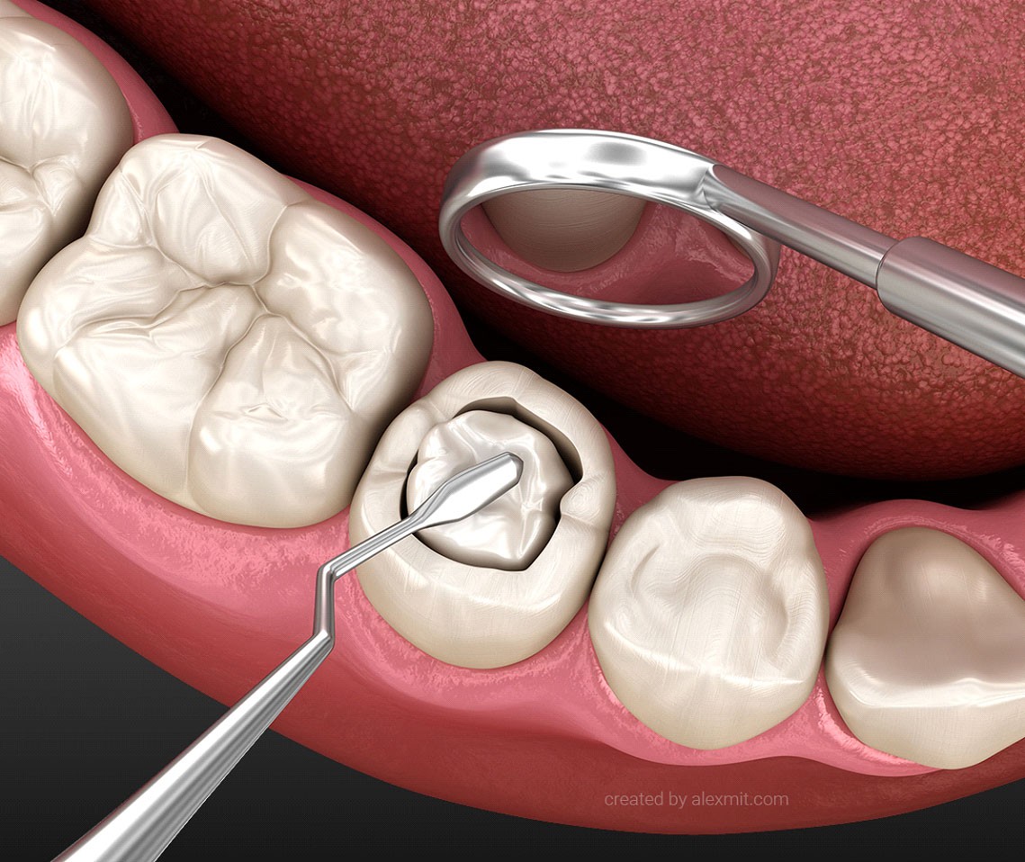 Восстановление кариозного зуба композитной пломбой. Медицински точная 3D-иллюстрация зуба.